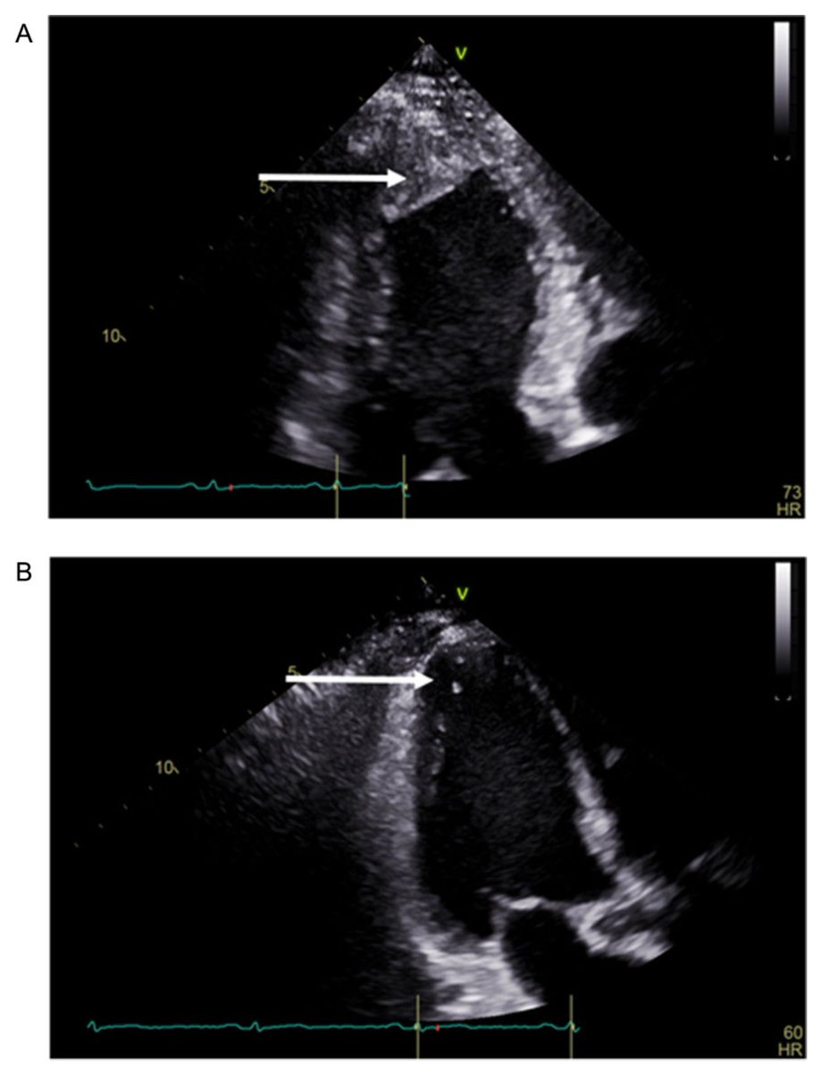 Should #guidelines recommend anticoagulation with #DOACs (instead of VKAs) to treat LV thrombus? A new RCT supports the use of #apixaban in clinical practice 💊⤵️ 
academic.oup.com/ehjcvp/article…
#EHJPharmacotherapy #CardioTwitter #ESCardioEd @AgewallStefan @ESC_Journals @escardio