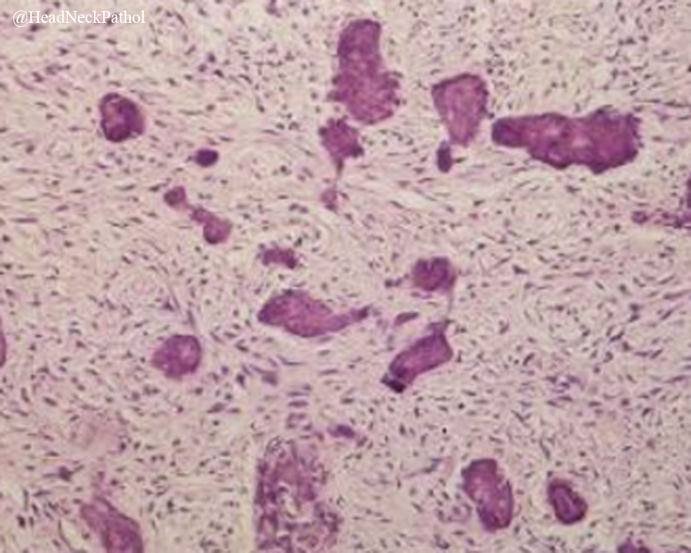 HeadandNeckPath's tweet photo. A Clinical, Radiological and Histopathological Review of 74 Ossifying Fibromas
By L. H. C. Collins, N. F. T. Zegalie, I. Sassoon &amp; P. M. Speight
https://t.co/34VP4SRYzD
#HeadNeckPathol #HNPJ #HeadandNeckPath #Pathology #ENTPath #PathologyTweet https://t.co/pcVBVmTB6y