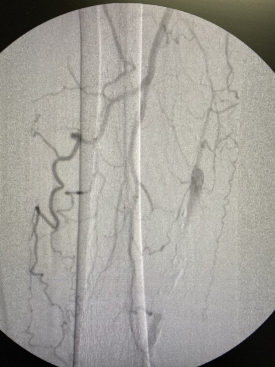 Revascularize's tweet photo. Initial angiogram https://t.co/Hxo1WKVyan