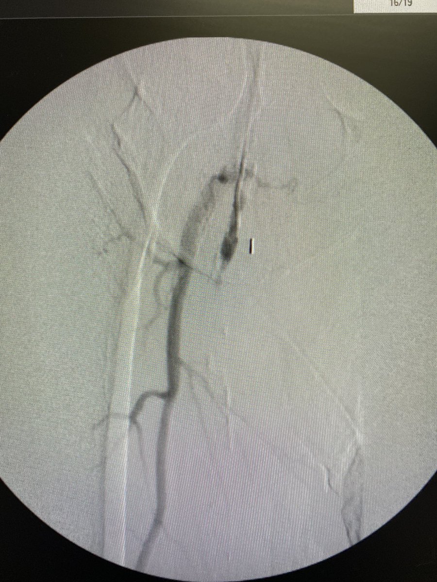 Revascularize's tweet photo. Initial angiogram https://t.co/Hxo1WKVyan
