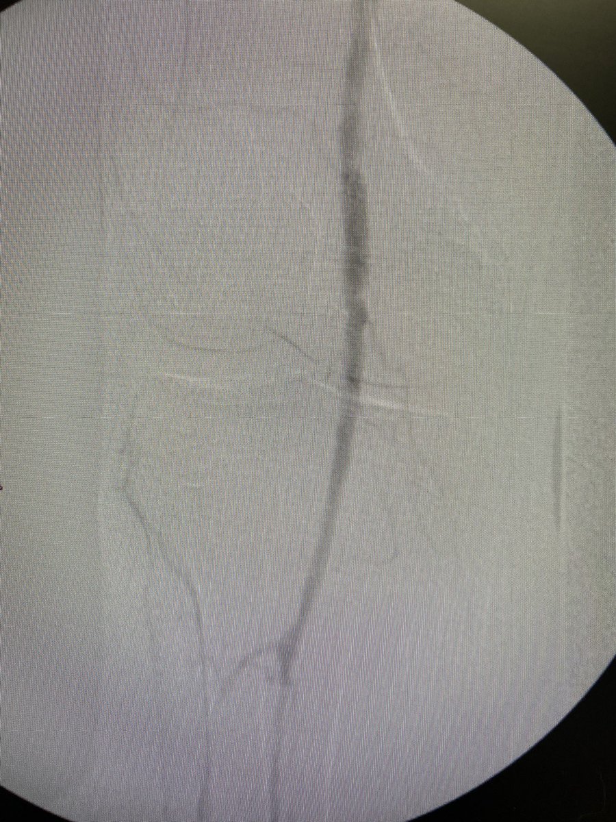 Revascularize's tweet photo. Initial angiogram https://t.co/Hxo1WKVyan
