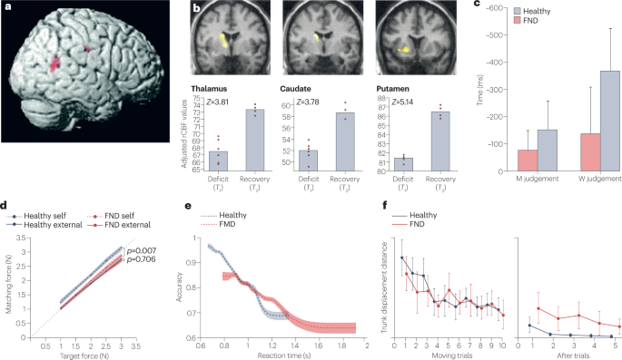 New online! Why functional neurological disorder is not feigning or malingering dlvr.it/SjWPJd