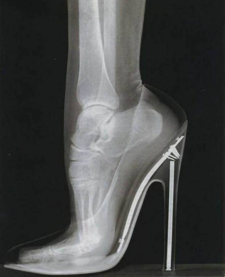 Esta radiografía nos muestra la postura de un pie cuando se usa un zapato de tacón alto.

Las zapatillas podrán resaltar la belleza de la mujer, pero la biología humana nos enseña que el cuerpo no está adaptado para este complemento.