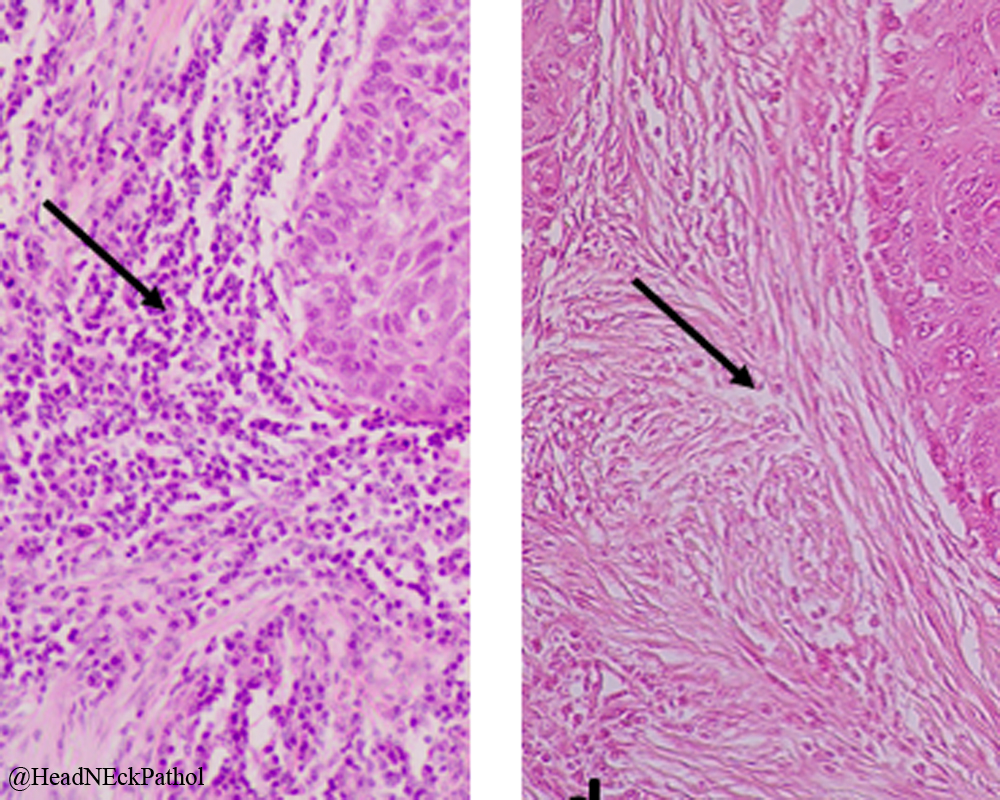 HeadNeckPathol's tweet photo. Cancer Microenvironment Defines Tumor-Infiltrating Lymphocyte Density &amp; Tertiary Lymphoid Structure Formation in Laryngeal Cancer
Gkegka, Koukourakis, Katotomichelakis et al
https://t.co/Uqrn5IRVRH
#HeadNeckPathol #HNPJ #HeadandNeckPath #Pathology #ENTPath #PathologyTweet https://t.co/0NgbVKuiqs