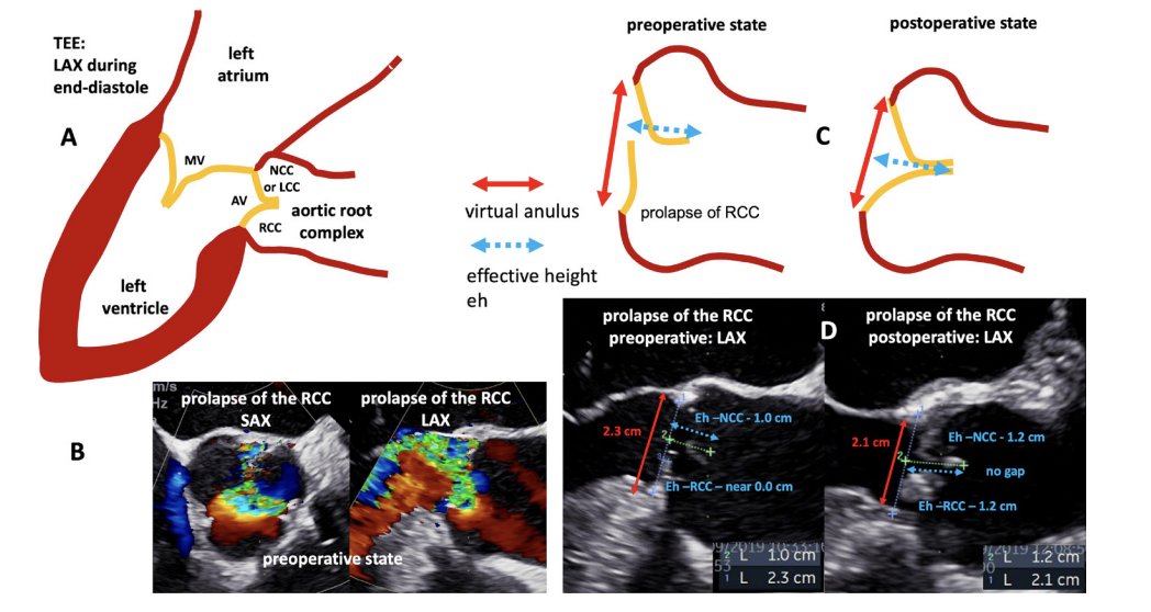 Aortic cusp abnormalities in patients with trileaflet aortic valve and root aneurysm bit.ly/3UgtLf0