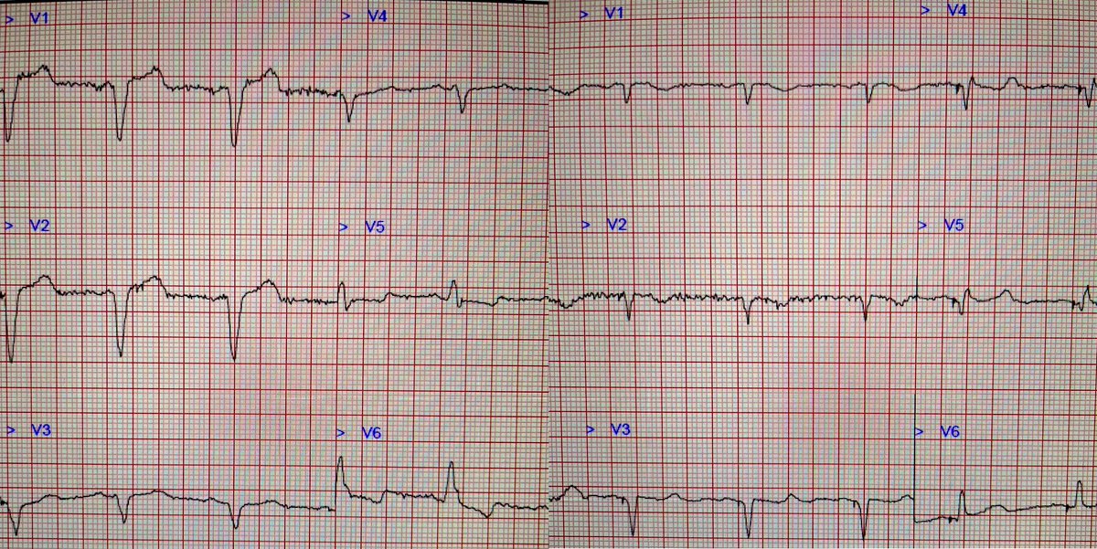Another great result in the lab yesterday 🫀 60% QRS reduction with SyncAV 👌 On track for a good response 💪 @jamesrfyoung <a href="/AbbottCardio/">Abbott Cardiovascular</a>