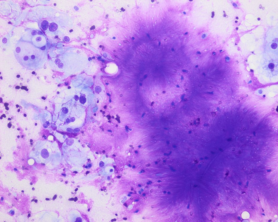 Part 2. It is amazing what "you" pathologists can do with just the location of the tumor and minimal clinical info. Next time I will show you just the image, with no other data. The antecendet of chordoma was known. We tested BRACHYURY just to gain experience. Excellent results