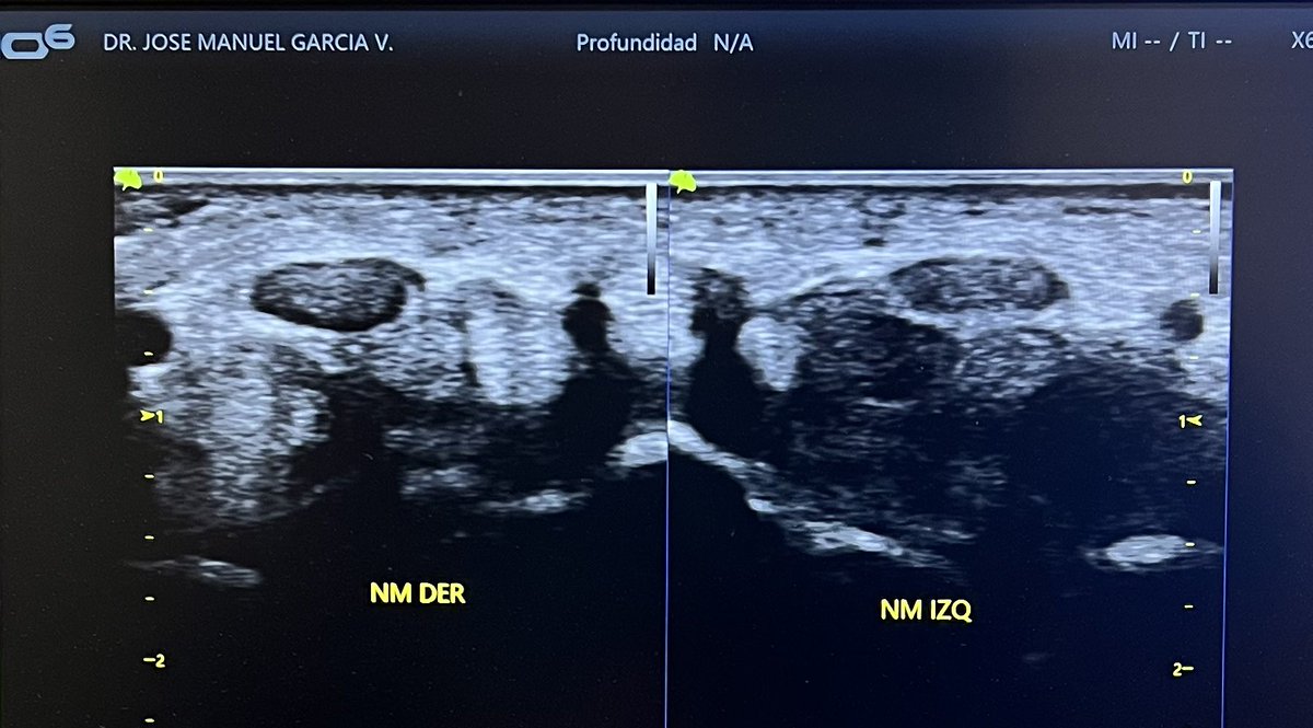 Nervio mediano. STC bilateral 14mm area