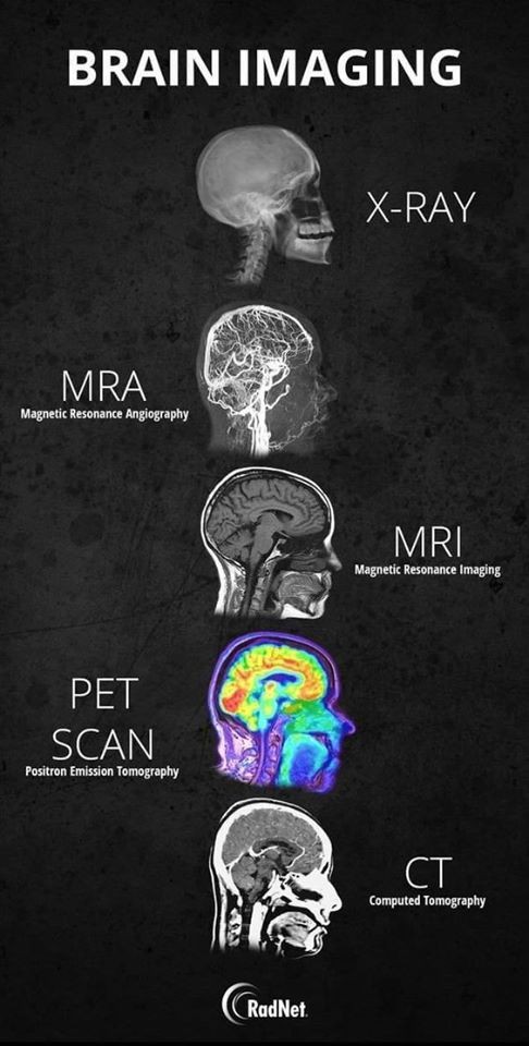 Brian imaging

#mri #radiology #xray #radiologist #medicine #ctscan #radiologia #medical #radtech #ct #imaging #radiographer #xraytech #medicalimaging #radiologytech #ultrasound #xrays #healthcare #doctor #radiologylife #radiologystudent