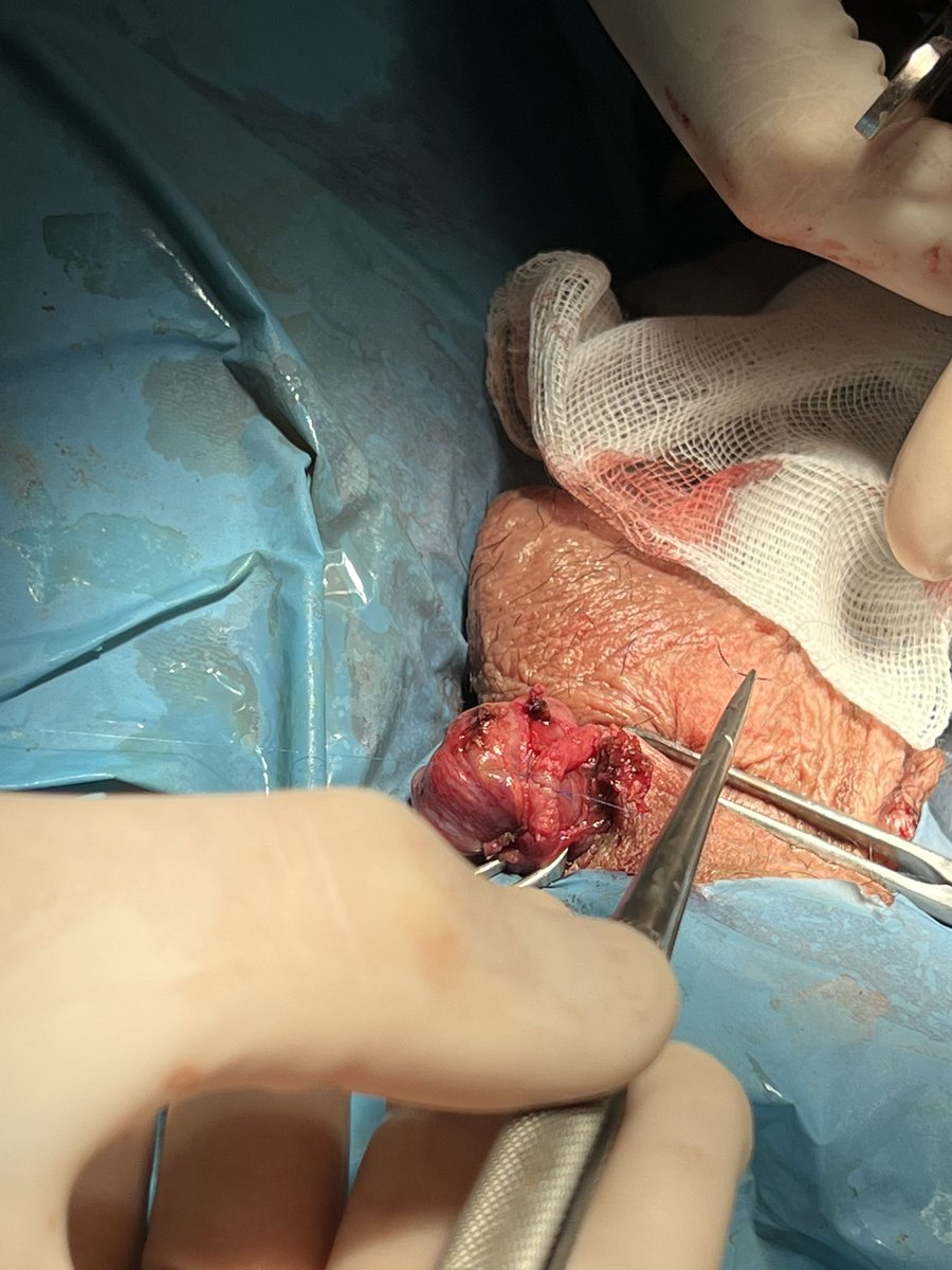 mdmancebo's tweet photo. Vasovasostomia junto al Dr Valle y Dra Dieppa!! #Urosome https://t.co/1NxQ7MiQxB