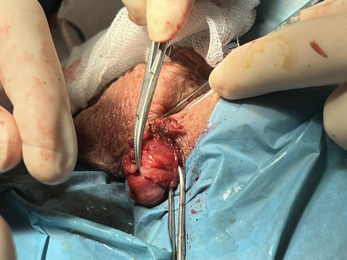 mdmancebo's tweet photo. Vasovasostomia junto al Dr Valle y Dra Dieppa!! #Urosome https://t.co/1NxQ7MiQxB