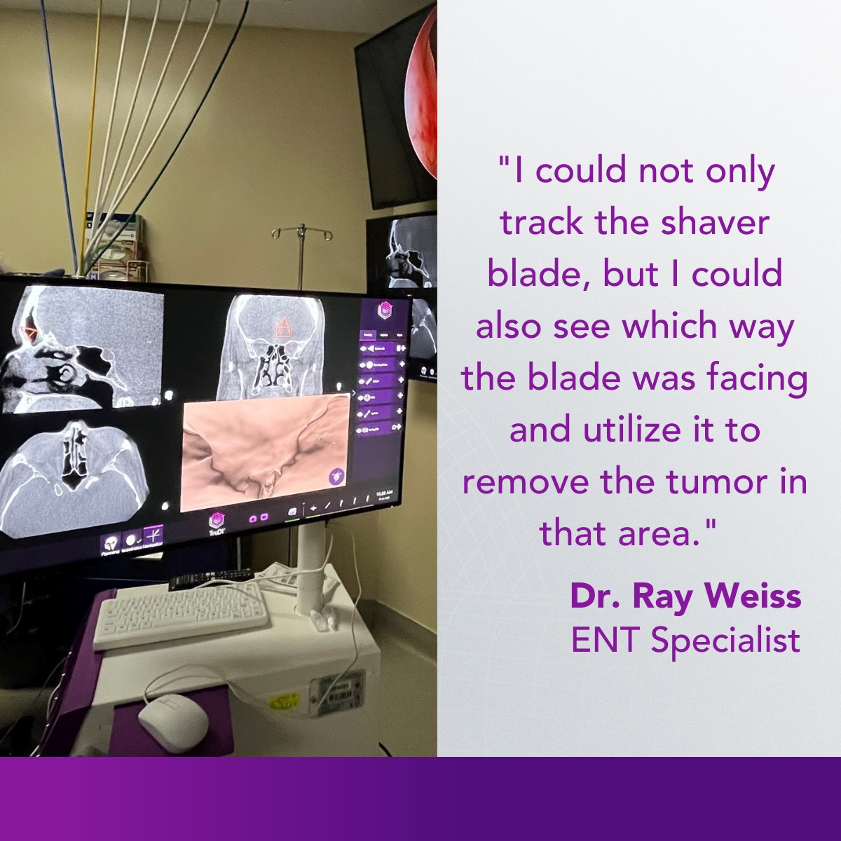 Acclarent's tweet photo. We are so excited to see more physicians using the TruDi® Shaver Blade! Dr. Ray Weiss, ENT specialist, used this innovative tool for a complex revision case.
For safety and risk-related information: https://t.co/HqoOw7DAyh
#ENT #Acclarent #Navigation https://t.co/DL6MIPyCN8