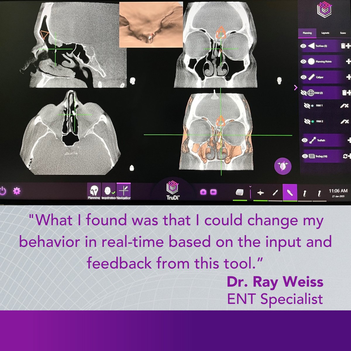 Acclarent's tweet photo. We are so excited to see more physicians using the TruDi® Shaver Blade! Dr. Ray Weiss, ENT specialist, used this innovative tool for a complex revision case.
For safety and risk-related information: https://t.co/HqoOw7DAyh
#ENT #Acclarent #Navigation https://t.co/DL6MIPyCN8
