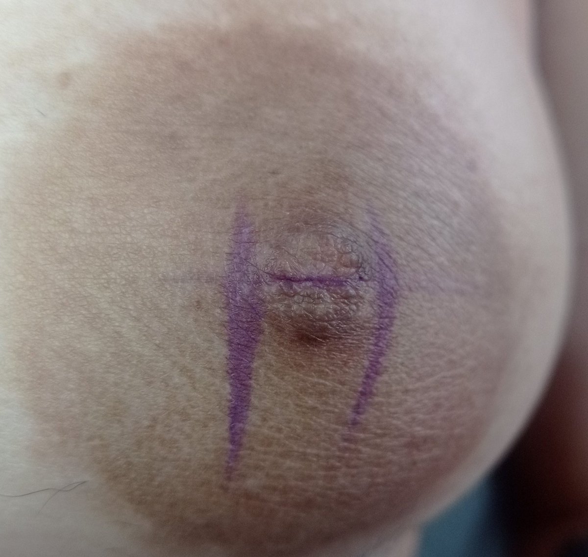 Perfuração no mamilo com joia anodizada em azul arroxeado 💙💜
E como podemos ver na última foto, era um mamilo bem plano mas isso não impede de marcar na brusinha! 😏