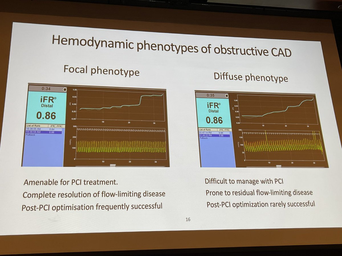 The iFR is 0.86 in both arteries but stent may not change the symptoms one vs the other. @JEscaned explaining physiology @PhilipsHealth @salome_snyders