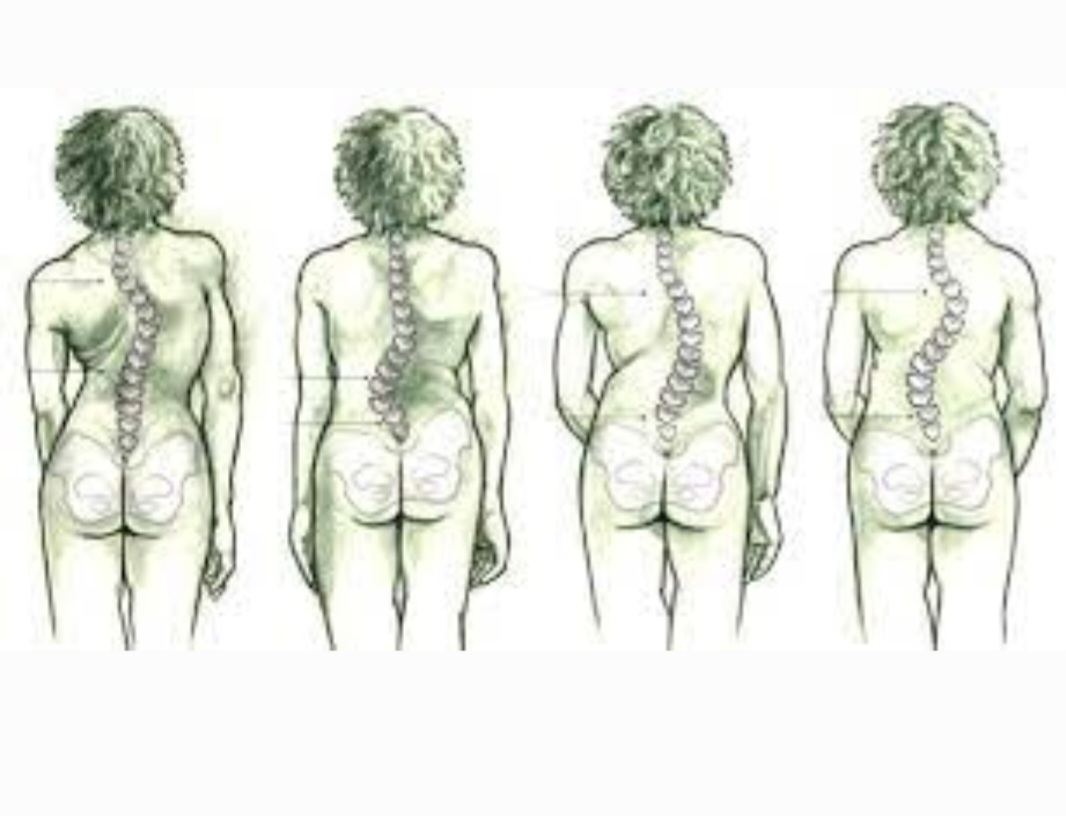 Op vrijdag is er #rugpoli in @olvg, wat aansluit op de onderzoeken waarbij ik betrokken ben. De #CURVE studie richt zich op het verminderen van #röntgenfoto's bij kinderen met #scoliose. De #DISCUS studie focust op de langetermijn resultaten van een brace of fusie OK bij scoliose