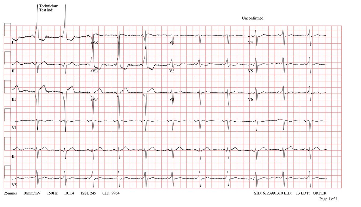 Karan Saraf (@drkaransaraf) on Twitter photo 1/3 Enjoyed mapping and ablating this challenging posteroseptal accessory pathway in a patient with WPW. Map/video in replies. <a href="/DrMAinslie/">Mark Ainslie</a> #EPeeps #CardioTwitter 1/3 Enjoyed mapping and ablating this challenging posteroseptal accessory pathway in a patient with WPW. Map/video in replies. <a href="/DrMAinslie/">Mark Ainslie</a> #EPeeps #CardioTwitter