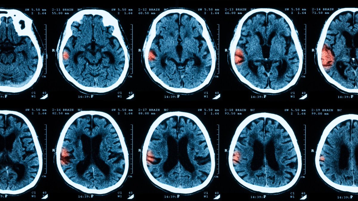 In this week's #ESOblog, @Tom_Moullaali writes about intracerebral haemorrhage assessment, consultation and treatment (ICH-ACT) and how to improve care for these patients. Read more: ow.ly/Qpn650MV3zP #stroke #strokeresearch #neurology @georgeinstitute @EdinUniBrainSci