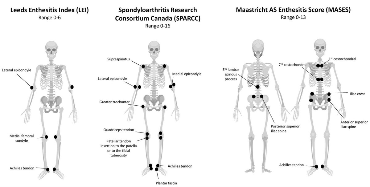 reumatoscience's tweet photo. Sistemas de pontuação de #entesite comumente usados ​​em ensaios clínicos de #artrite psoriásica.

https://t.co/UuZFz0SiZT https://t.co/EVj00qcWJK