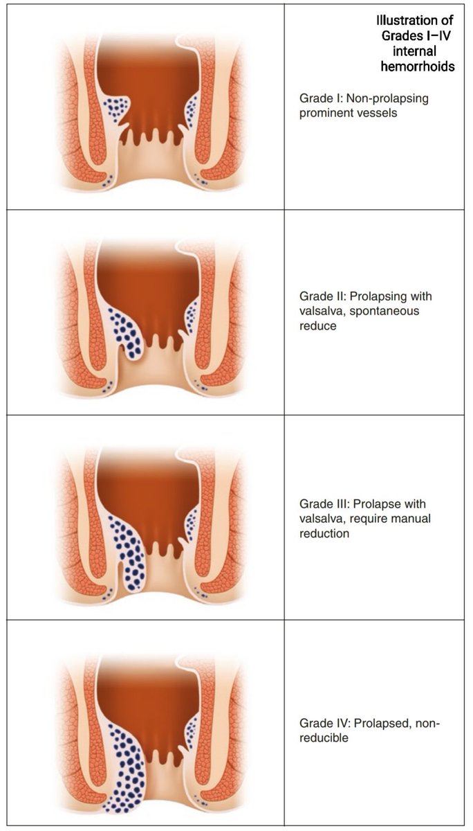 Medical_MD1's tweet photo. Quick Review ✨

Haemorrhoids🧐
Pathogenesis and grading 

. https://t.co/tZtLzulmK4