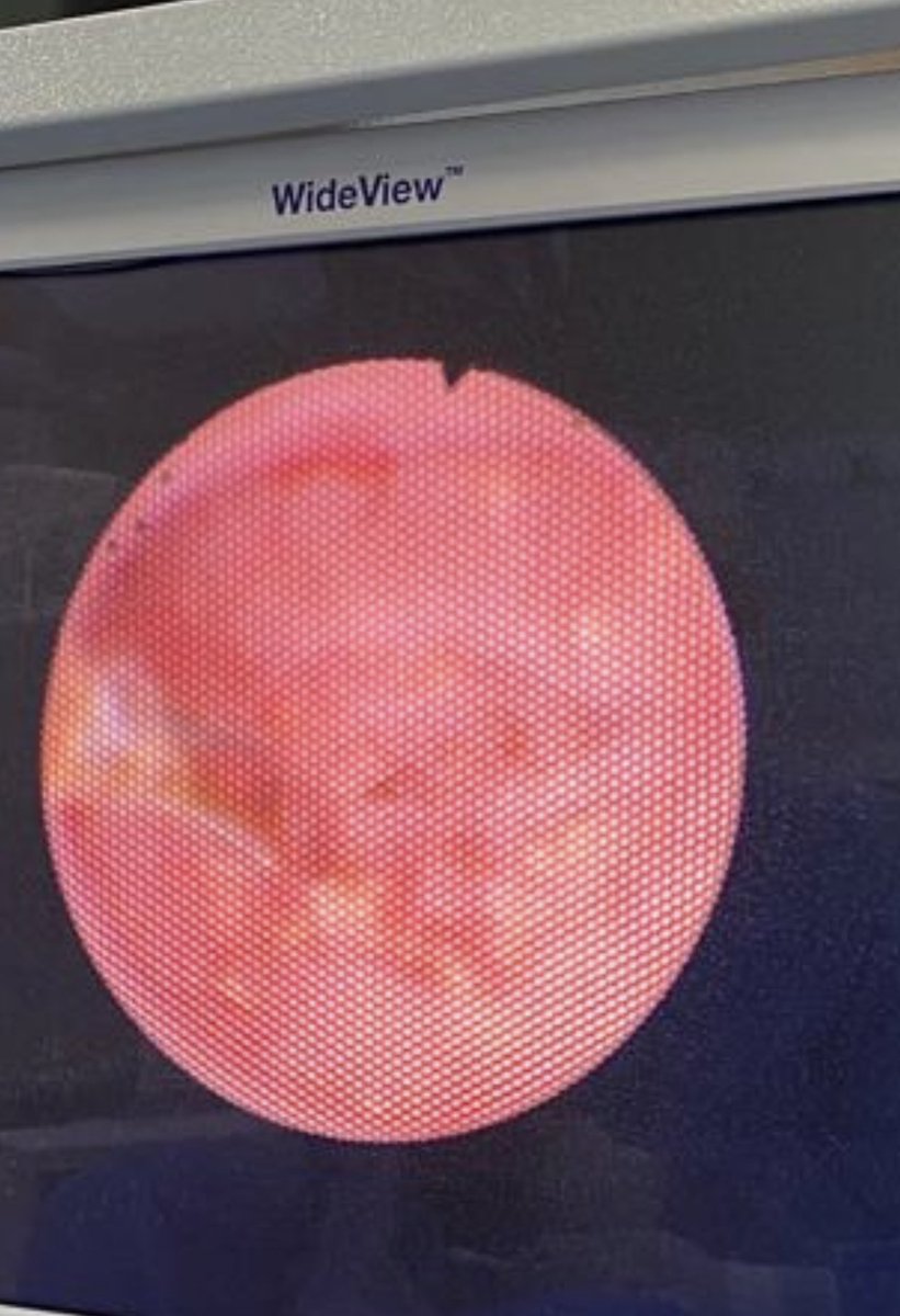Bad prognosis in recurrently caliceal small stones. Microcalculi emerging from renal papilla