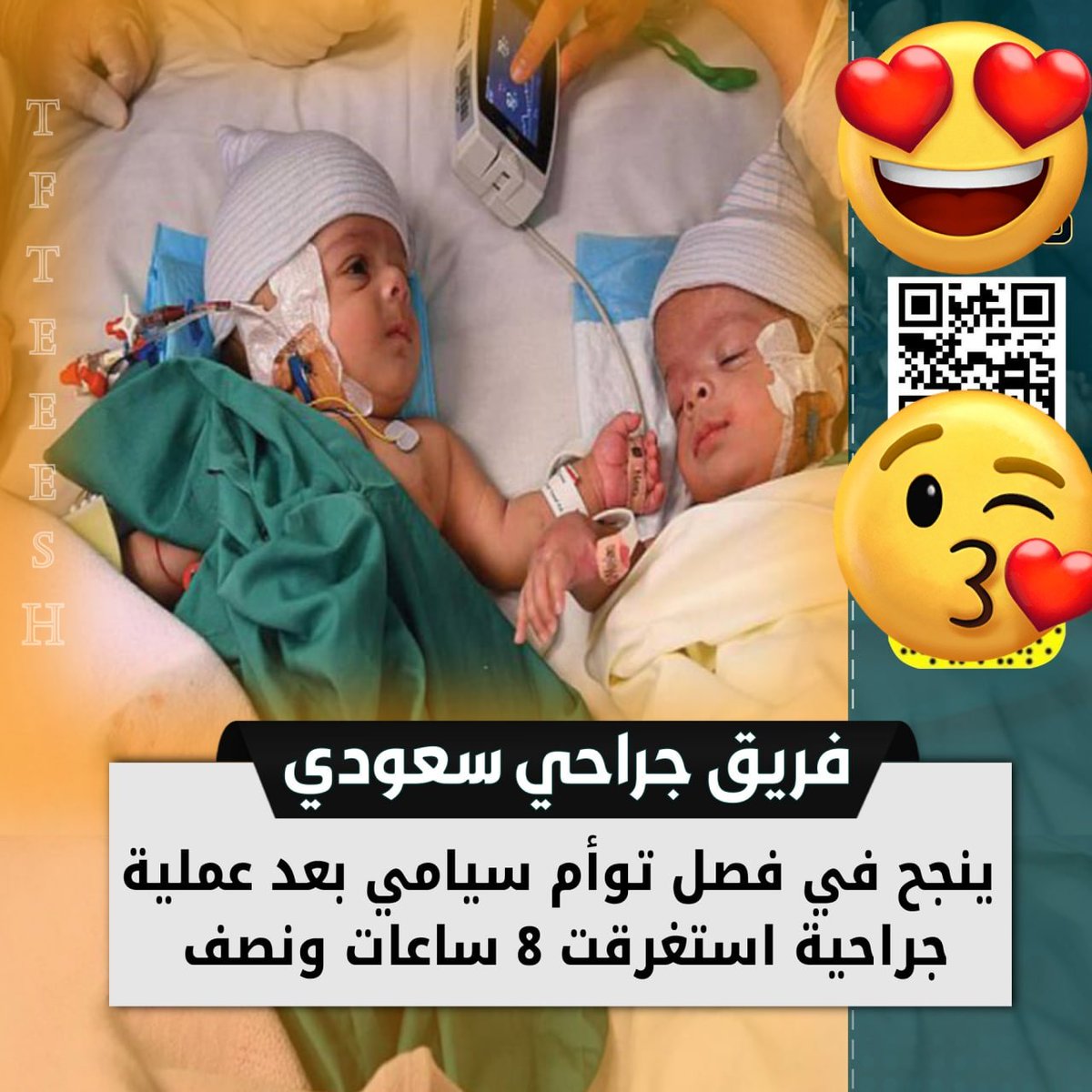 عملية  ناجحة  بارك الله بالدكتور  والمساعد 
ومن عمل العملية على  حسابه 
وبارك الله  لأبو  ولام  التوامين