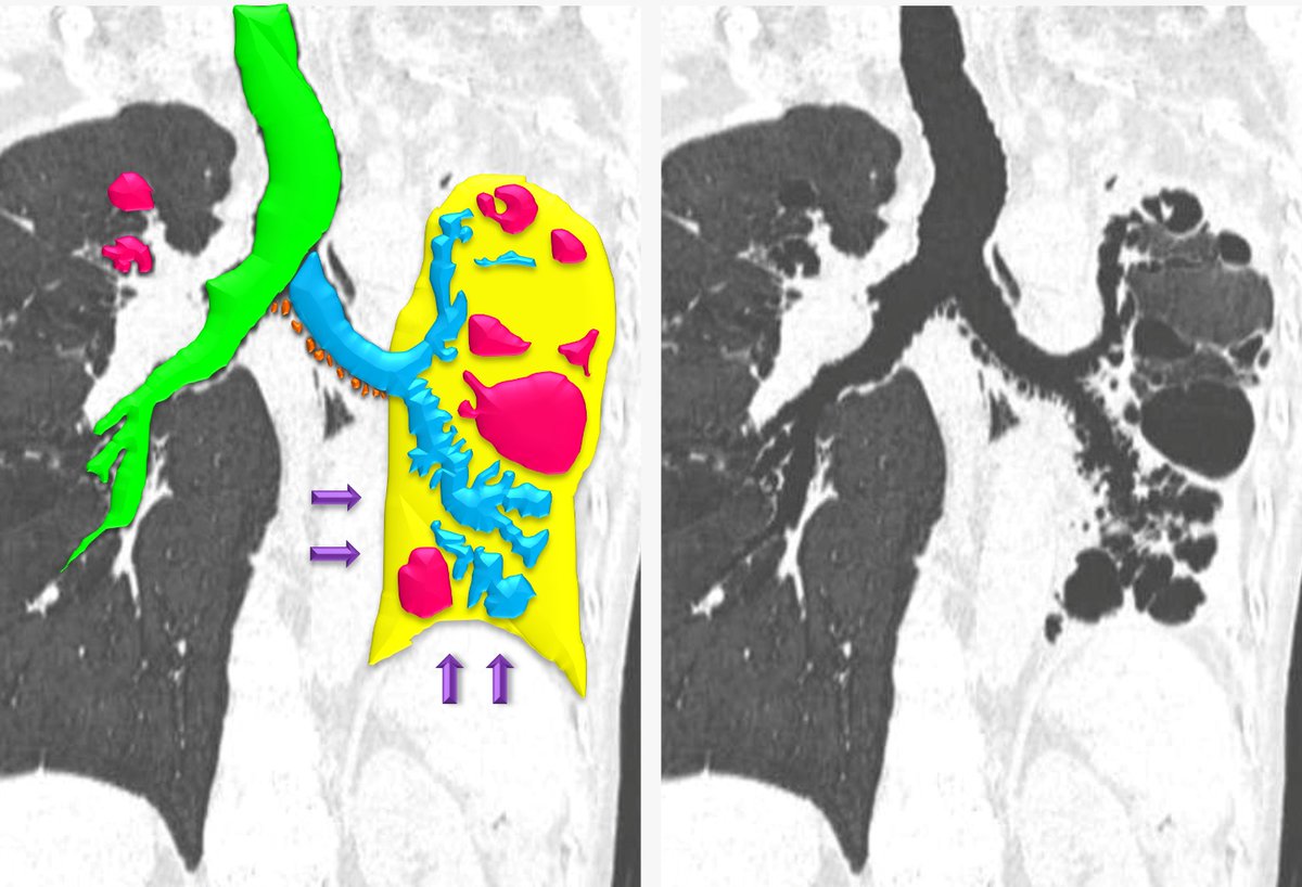 Dra. Cecilia Ferrario on Twitter "47 ♀️ post TB sequelae 🫁 CT shows 🟢