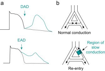 “Antiarrhythmic drugs and anaesthesia: part 1. mechanisms of cardiac arrhythmias.” #FOAMcc #FOAMem #FOAMed #MedEd #IntensiveCare #CriticalCare #BasicScience @BJAJournals 📚 bjaed.org/article/S2058-…