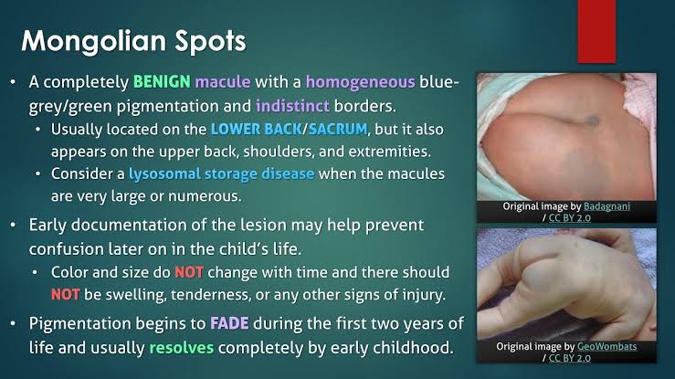 @BrownJHM @VisualDx Mongolian spot
Congenital dermal melanocytosis
Normal finding
No need to treat
Reassuring the parents is enough

flat bluish- to bluish-gray skin markings commonly appearing at birth or shortly thereafter. They appear commonly at the base of the spine, on the buttocks and back