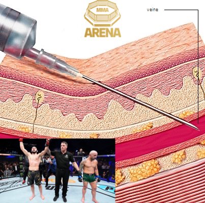 MMArena_'s tweet photo. On entend tout et n’importe quoi sur l’intraveineuse (IV) et Islam Makhachev 

Mais qu’est que l’IV et pourquoi est-il interdit ?

N’hésitez pas à partager les mini-threads comme ca, c’est encourageant 

⬇️⬇️ https://t.co/nRex5wktSH