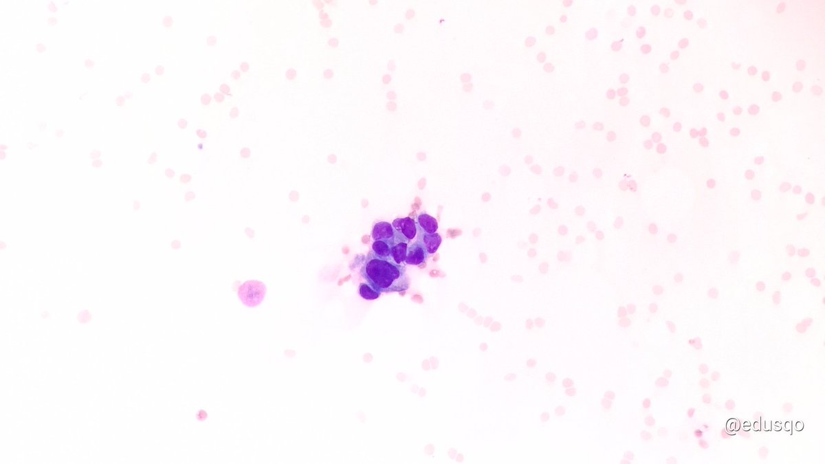edusqo's tweet photo. Fine-Needle Aspiration is a rapid and safe technique very useful as a first line in cases of skin metastases. At the same time FNA is minimally invasive and cost-effective procedure.
#FirstDoNotHarm #PrimumNonNocere
#FNAFriday #PulmPath meets #DermPath #CytoPath https://t.co/Rj4Q00Woso