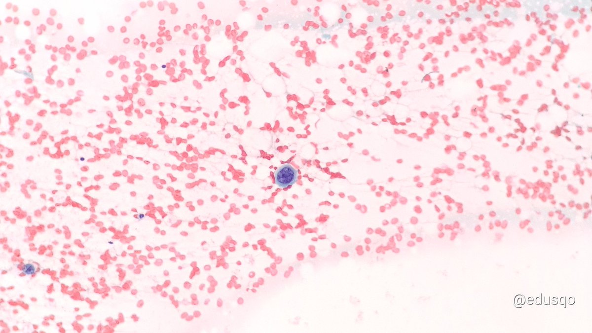 edusqo's tweet photo. Fine-Needle Aspiration is a rapid and safe technique very useful as a first line in cases of skin metastases. At the same time FNA is minimally invasive and cost-effective procedure.
#FirstDoNotHarm #PrimumNonNocere
#FNAFriday #PulmPath meets #DermPath #CytoPath https://t.co/Rj4Q00Woso