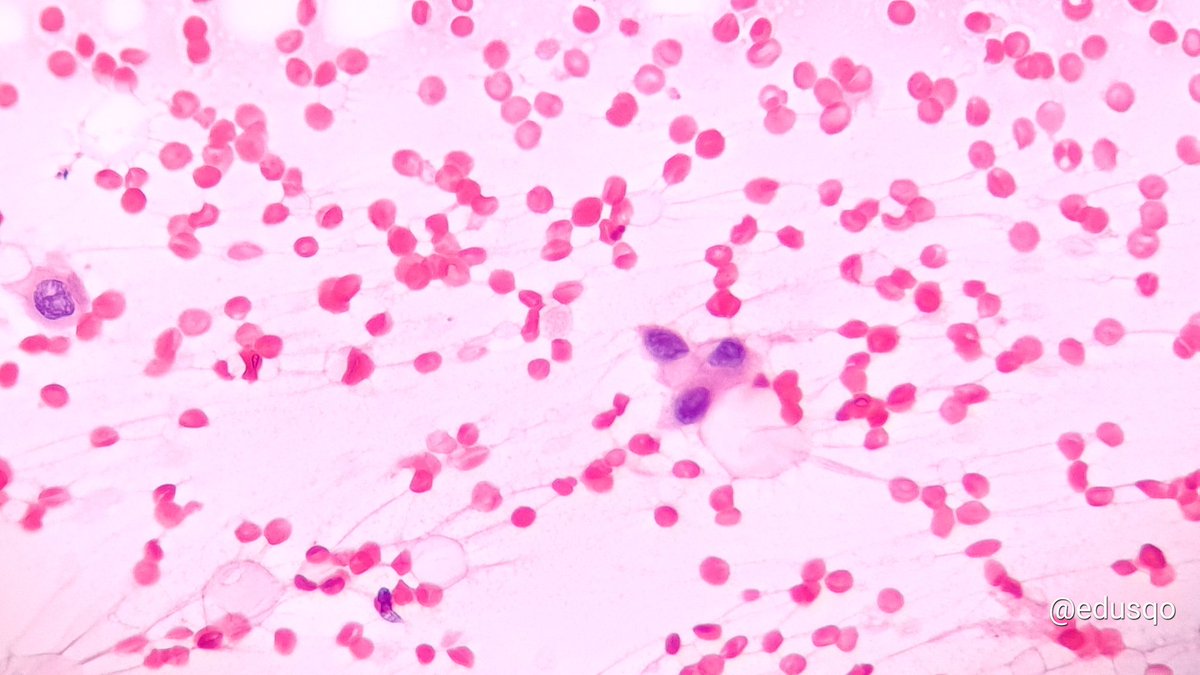 edusqo's tweet photo. Fine-Needle Aspiration is a rapid and safe technique very useful as a first line in cases of skin metastases. At the same time FNA is minimally invasive and cost-effective procedure.
#FirstDoNotHarm #PrimumNonNocere
#FNAFriday #PulmPath meets #DermPath #CytoPath https://t.co/Rj4Q00Woso