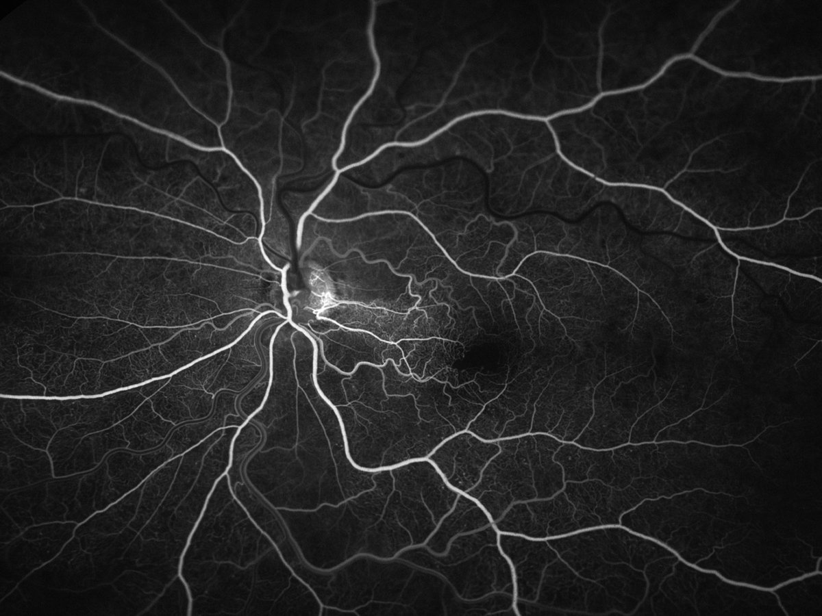 ScienceMagazine: Harnessing structural and immunological techniques, scientists identify immunogenic factors leading to immune complexes that may explain why #brolucizumab can elicit rare cases of retinal side effects in patients. @ScienceTM …