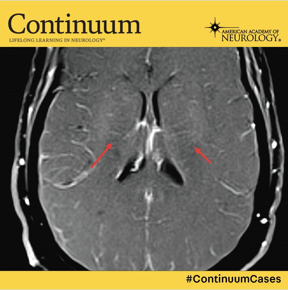 My 1st #ContinuumCase!
A young 👩‍🦰 presents with headaches &amp; confusion. 

She is febrile🤒, tachypneic, &amp; tachycardic.

She rapidly develops stupor &amp; abnormal stereotyped movements + inverse ocular bobbing. 

She is started on empiric therapy &amp; stabilized. 

An MRI is performed🔽