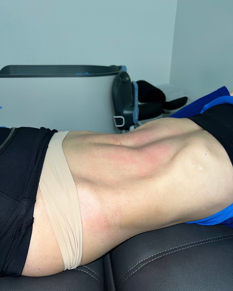 PUREHealthMiami's tweet photo. Results from one of our patients that is an avid runner and a mother of three.  #emsculpt brought back the abs and shred she was wanting. Multiply your results!!

Come in for a complimentary consult with one of our providers to see how we can help you achieve your goals.

⭐️ https://t.co/ef3nHqGIFC