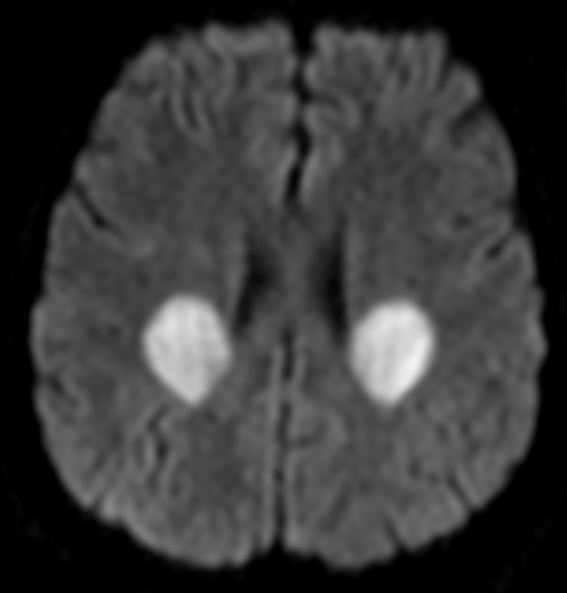 Tip of the day 💡: When typical phenomena become too overt, we should still remain confident and call spade a spade- like in this unfortunate child with methotrexate toxicity. Remain firm in your convictions this weekend.