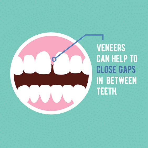 KitsFamDental's tweet image. #Dentaltip Embrace it or fix it! #dentalhealth #teethgap #teeth #dentalhygiene #oralhealth #oralhygiene #dentists #vancouverdentists