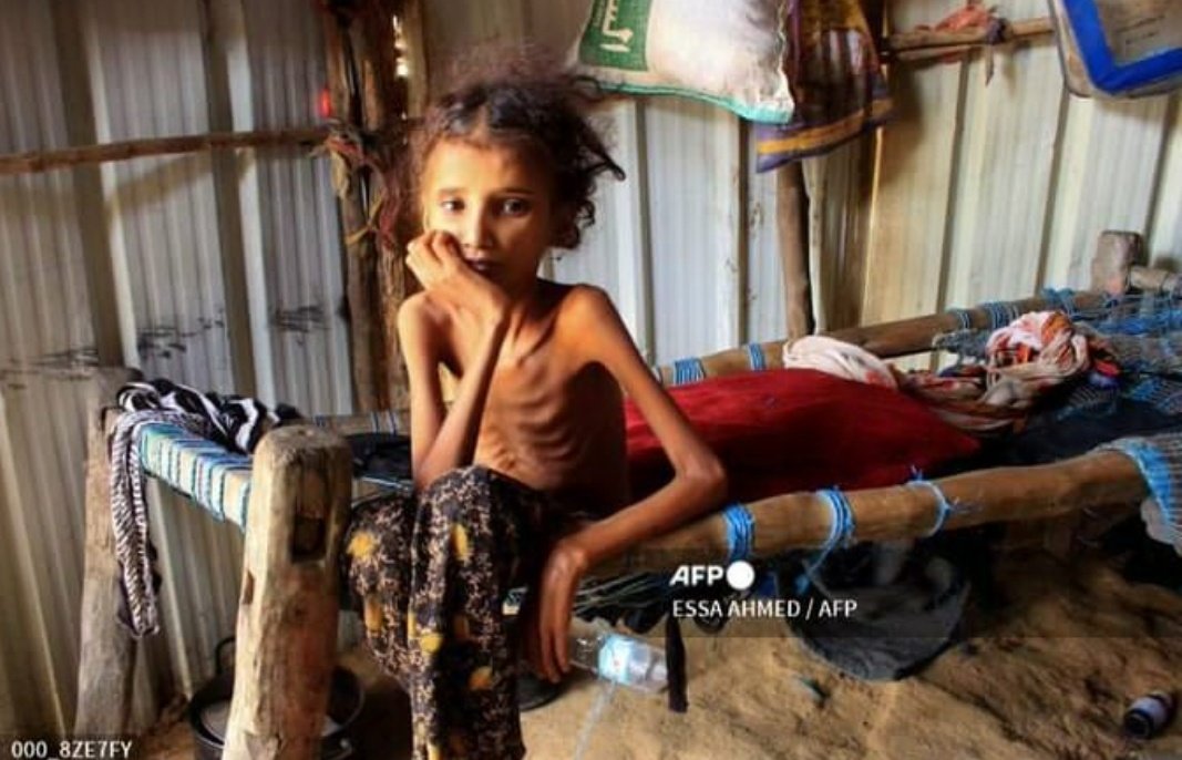 This is #Yemen!😭
(Hypocritical world) 

#YemenCantWait 
#OpYemen 
#Anonymous

Help to feed yemen children and donate today at 
gogetfunding.com/emergency-appe…