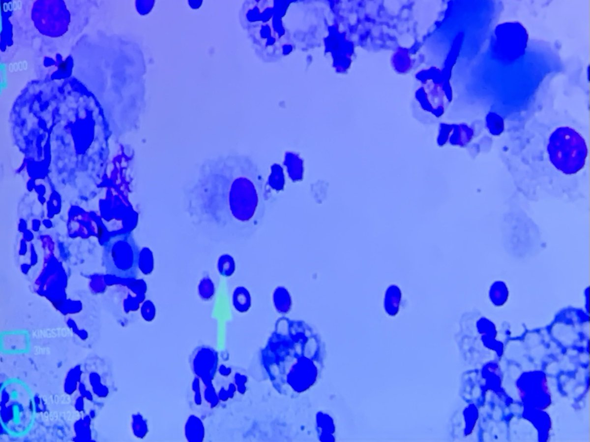 ECUHealth_ID's tweet image. Micro/Path rounds #cryptococcus   BAL… nice capsule 🔬 creamy, mucoid colonies 🧫 #IDFellowship #microbiology #IDTwitter