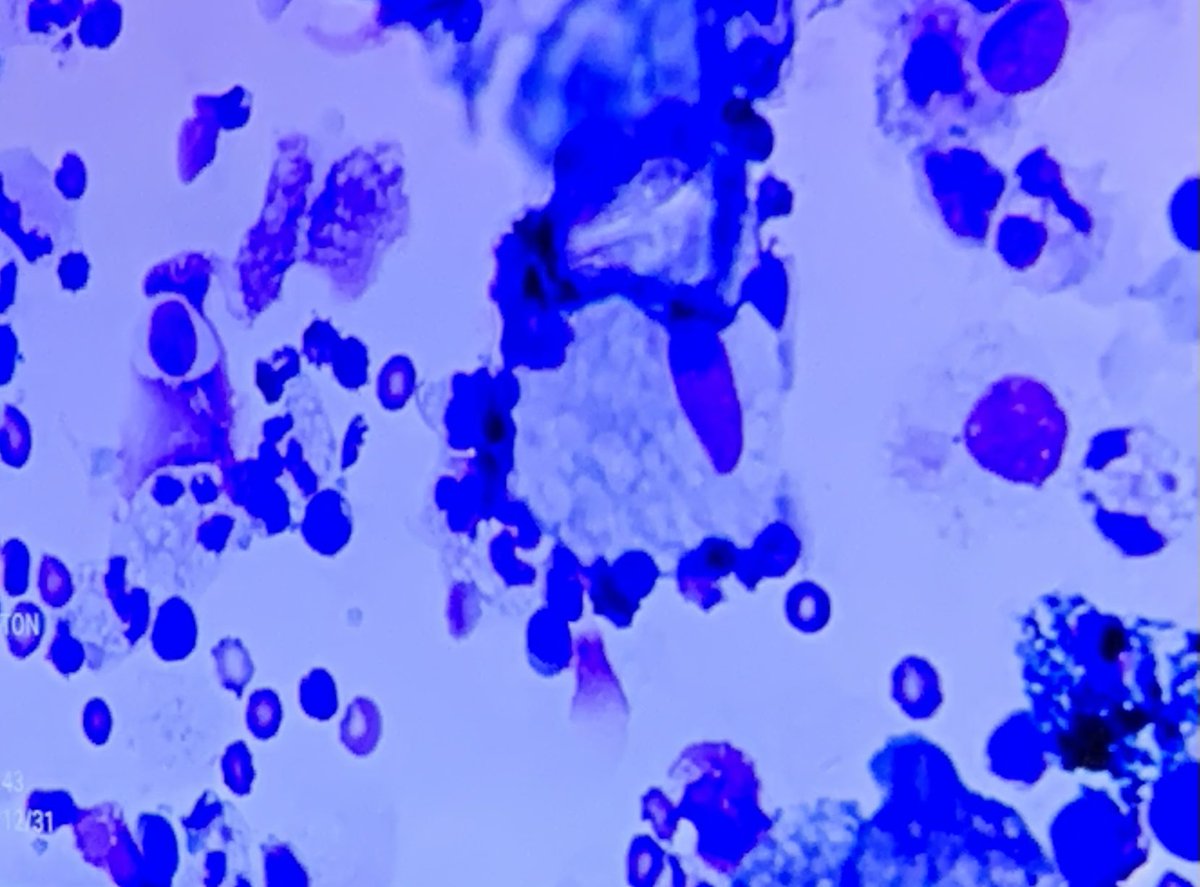 ECUHealth_ID's tweet image. Micro/Path rounds #cryptococcus   BAL… nice capsule 🔬 creamy, mucoid colonies 🧫 #IDFellowship #microbiology #IDTwitter