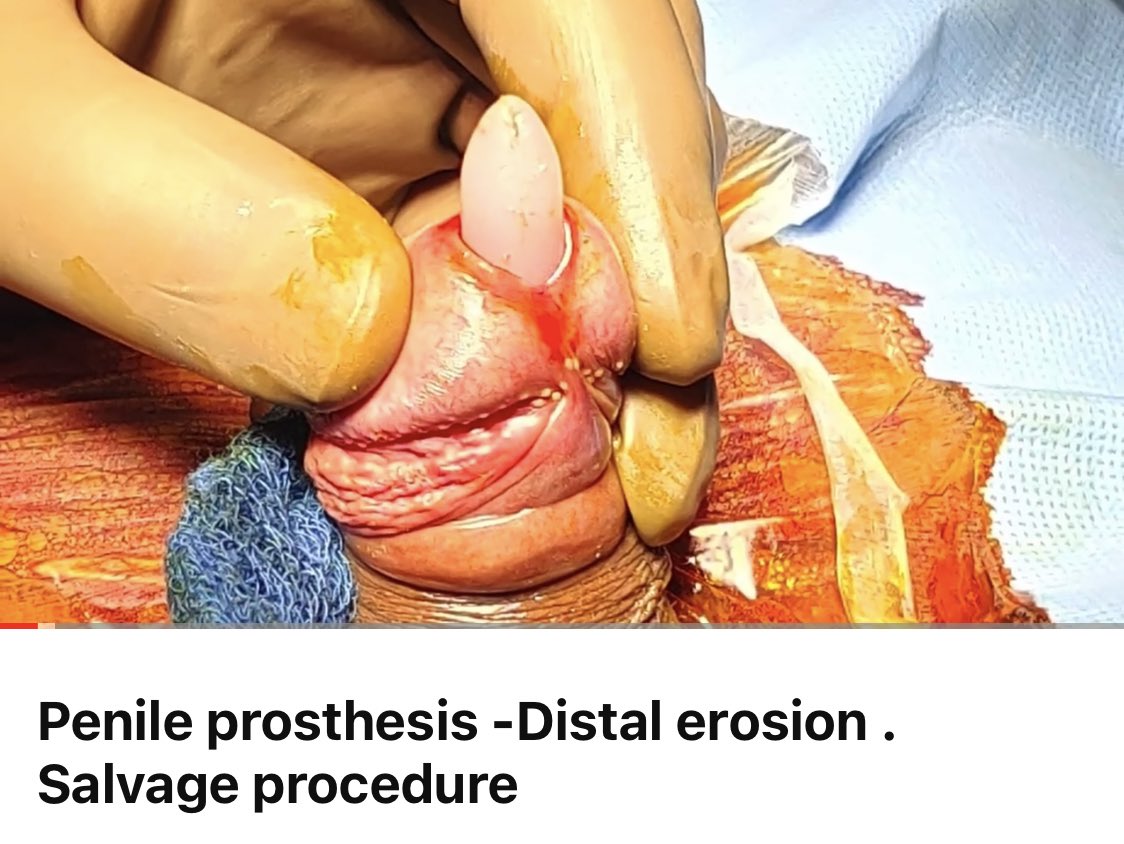Penile prosthesis urethral erosion can be salvaged . It’s a precious corpora , post pelvic fracture U’plasty                                                      youtu.be/nFtJLYc5rao                 <a href="/SocietyGURS/">GURS</a> <a href="/andrology_open/">Andrology Open Access</a> <a href="/AmerUrological/">Amer. Urol. Assn.</a> <a href="/USANZUrology/">USANZ</a> <a href="/brurology_group/">Brazilian Reconstructive Urology Group</a>