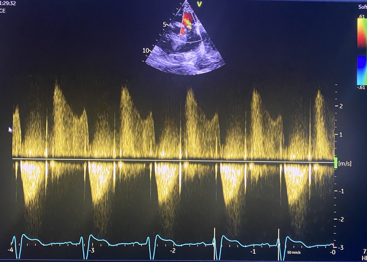 PR jet Doppler for fellows. Your inference?