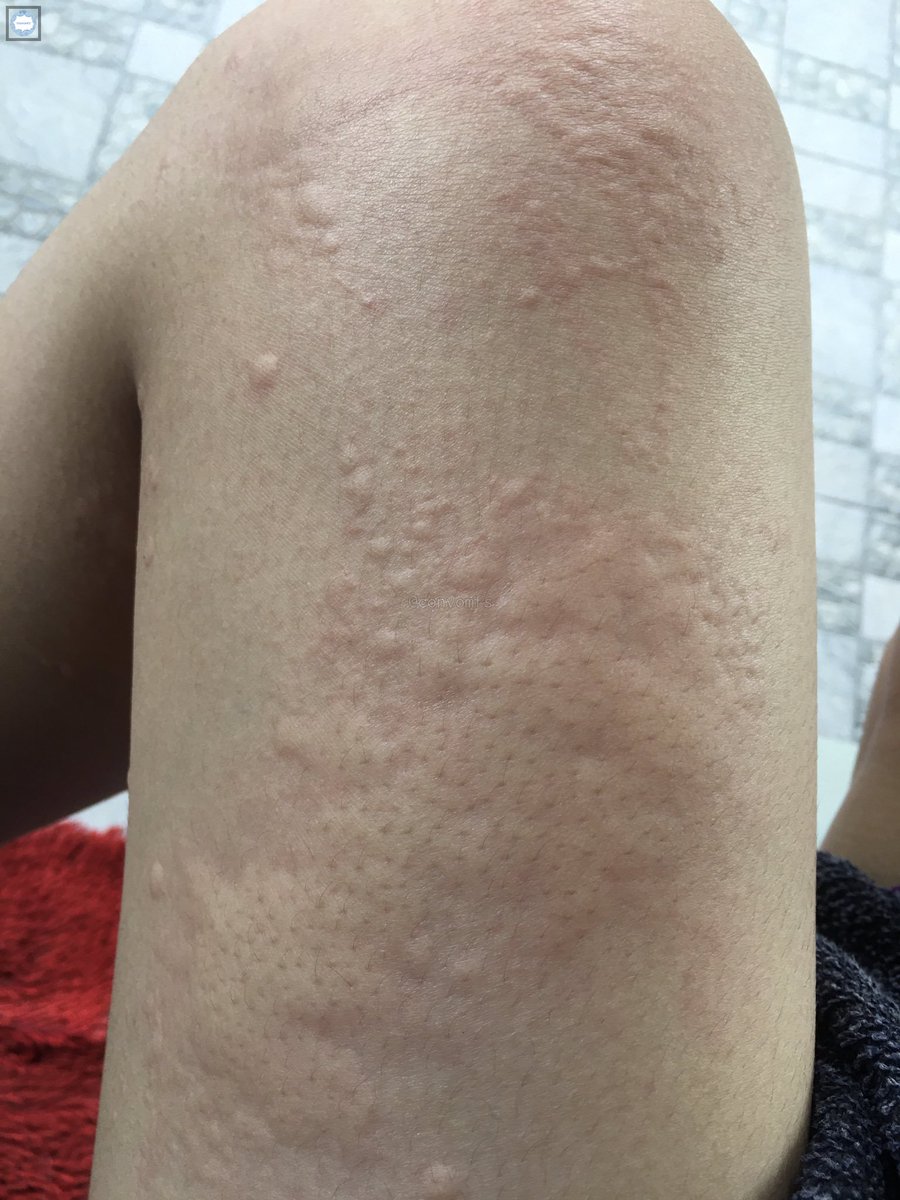 convomfs's tweet photo. Tw // bentol bentol
.
.
.
.
.
.
.
.
guys ada yg pernah/lagi ngalamin ginian ga? ini nama penyakitnya apasih? parah gatel banget jadi gua garuk 🤍 https://t.co/M6gDaJfaYp