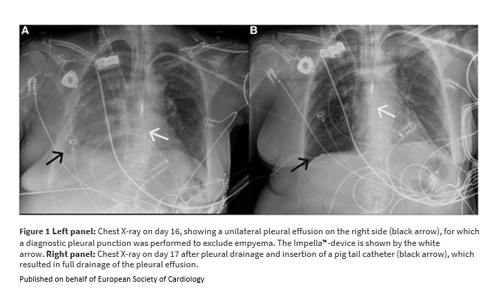ESC_Journals's tweet image. #CathLabHack: Switch to a bicarbonate-based Impella CP™ purge solution in a patient with haemothorax academic.oup.com/ehjcr/article/…

#EHJCaseReports #YesCCT #ImageFirst #RadialFirst @KardiologieHH @aayshacader @ANazmiCalik @EHJCREiC @TJ_Yeo @cfcamm @FarhanaAra @HikmetKadi