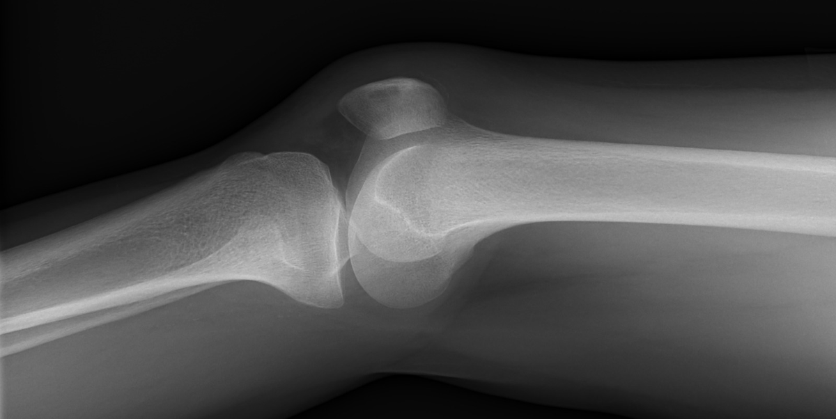 mskteachingroom's tweet photo. New day 🌞New case😎

27👨- sustained trauma to knee. 

What do you see? 🧐

MR images coming up later!

#radfellow #radiologyresident #learningradiology #radres #mskrad #radtwitter #radiology #transformingradiology #mri 
@radRounds https://t.co/Tw0GKMitaP