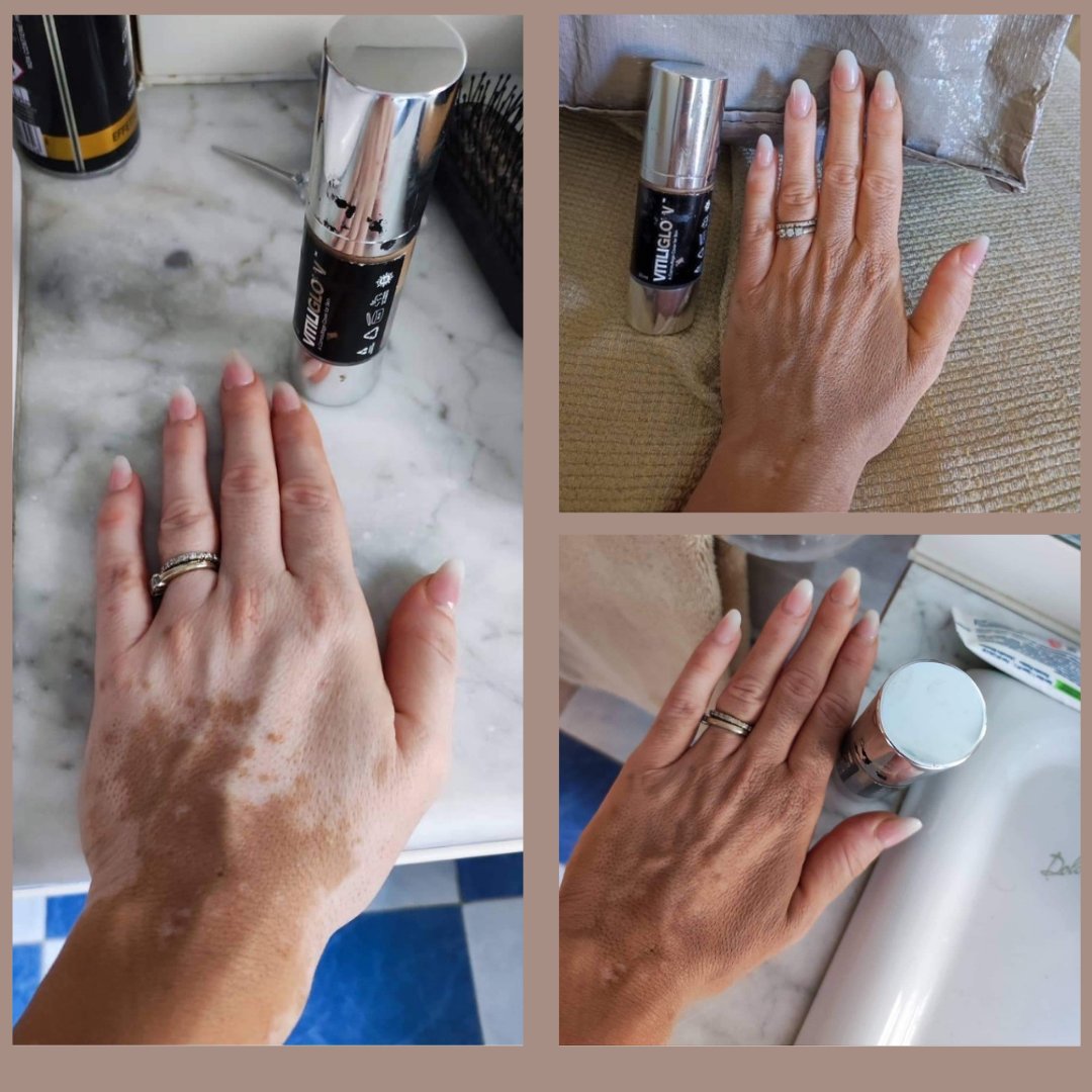 VitiliglowInfo's tweet image. VITILIGLOW® was designed for those specifically with Vitiligo, and provide long lasting cover.  The picture is from a customer who uses tan-medium. Find out more at vitiliglow.co.uk
#vitiligo #vitiligocover #vitiligoawareness #depigmentation #vitiligocamouflage