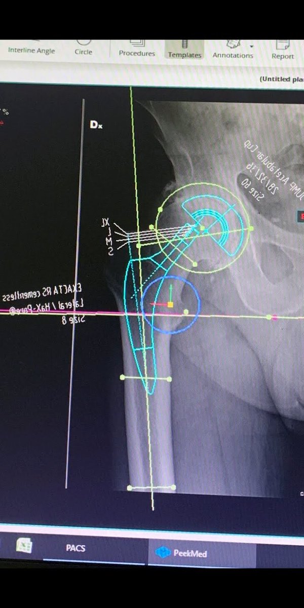 In compenso di studia e si guarda il lavoro degli amici ....un bel progettino di anca ...#AnkleSurgery #MedicalClinic