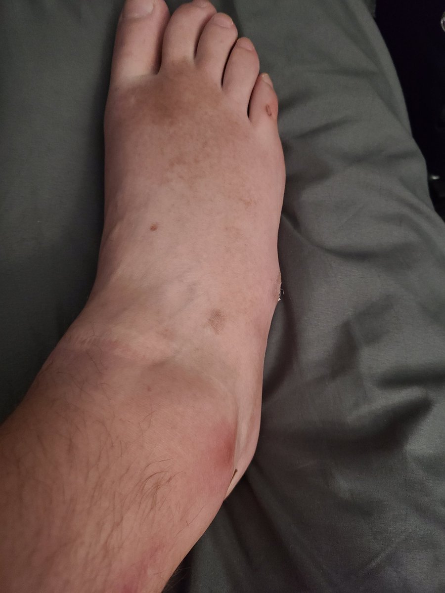 UnstoppableG89's tweet image. I&apos;m paralyzed from the chest down and slid off my bed only to land on my ankle...needless to say, I have a rough day yesterday! I&apos;m going to need whatever they gave @PatrickMahomes
 at halftime! 😅😬
#disabledproblems #GravityWins #hurtslikehell