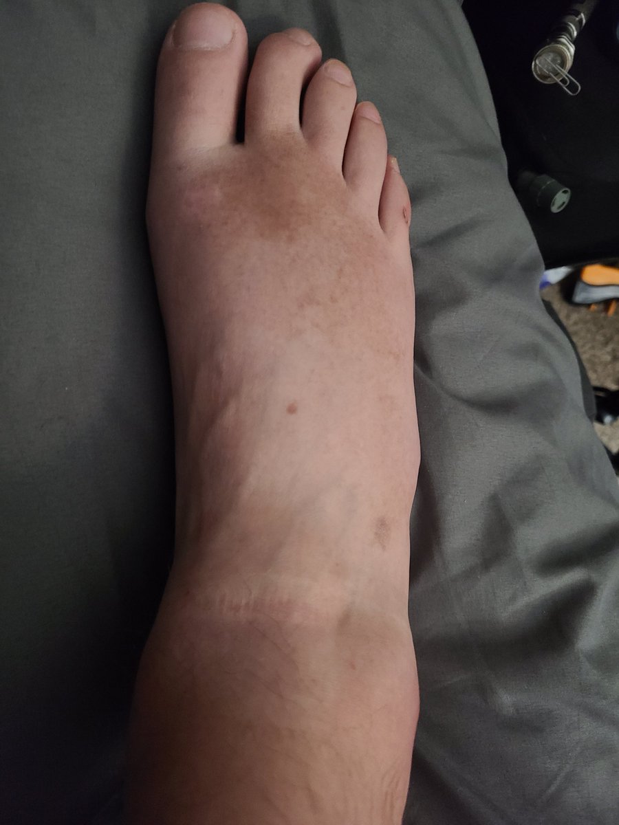 UnstoppableG89's tweet image. I&apos;m paralyzed from the chest down and slid off my bed only to land on my ankle...needless to say, I have a rough day yesterday! I&apos;m going to need whatever they gave @PatrickMahomes
 at halftime! 😅😬
#disabledproblems #GravityWins #hurtslikehell